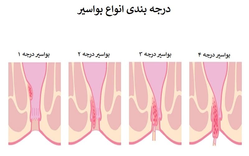 درجه بندی بواسیر
