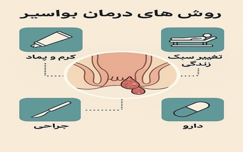 روش های درمان بواسیر