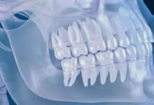 تصویربرداری CBCT قبل از کاشت ایمپلنت