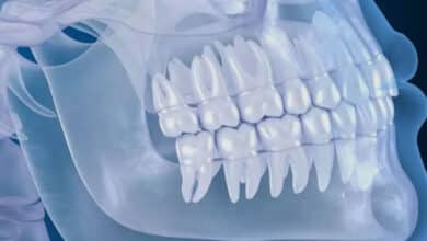 تصویربرداری CBCT قبل از کاشت ایمپلنت