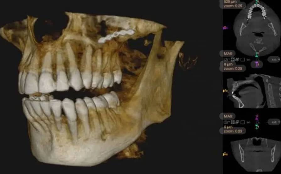 چرا CBCT قبل از ایمپلنت مهم است؟