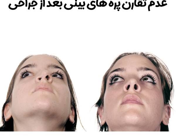 عدم تقارن پره های بینی بعد از جراحی