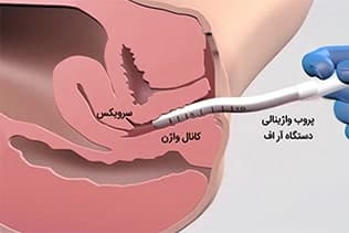 مراقبت ‌های بعد از RF واژینال