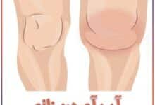 آب آوردن زانو - دکتر علیرضا عسکری