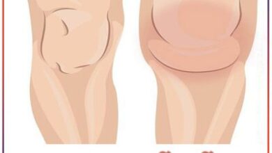 آب آوردن زانو - دکتر علیرضا عسکری