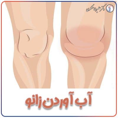 آب آوردن زانو - دکتر علیرضا عسکری
